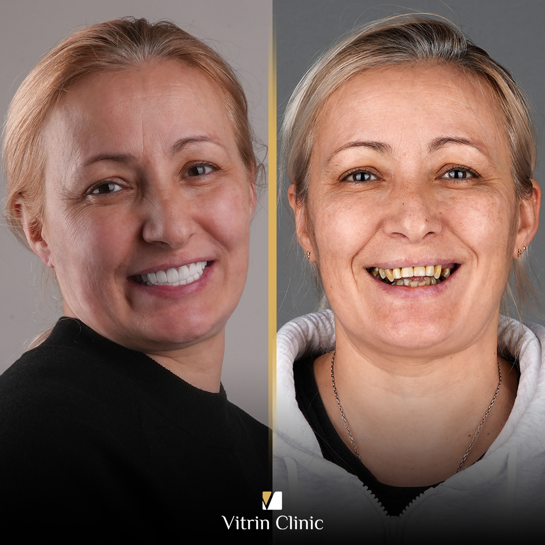 Systemic Conditions and Dental Implant Loss: What Are the Risks and Can You Prevent Them?